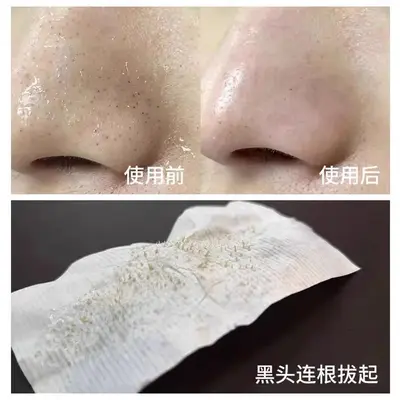 正品柏翠丝茶树去黑头套盒深层清洁收缩毛孔闭口精华导出液鼻贴