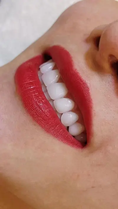 Yiohjia All-Ceramic Dental Veneer Porcelain Laminate, Blue Ceramic, Amber Ceramic, Lingxi Ceramic, Handmade Porcelain, Fluorosis Teeth Whitening Teeth - 13