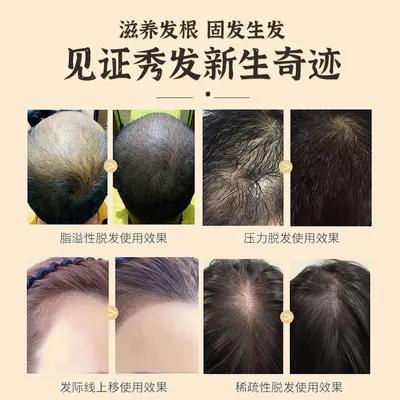 育发液增发密发防脱修护发根浓密发际线生长剂护发植物提取液厂家