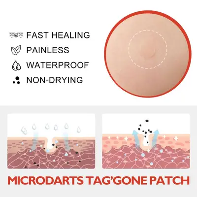 OUHOE Acne Patches, Skin Clearing, for Warts and Corns - 4