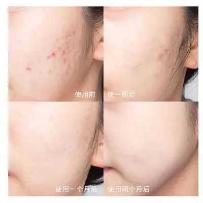 草本高端祛痘膏去青春痘粉刺闭口男女通用温和淡化痘印痘坑祛痘霜