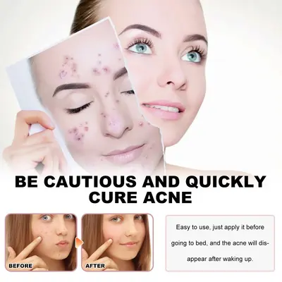 Limited-time discount Jaysuing cute colorful acne patches, fade pimples and blackheads, care for facial skin, concealer