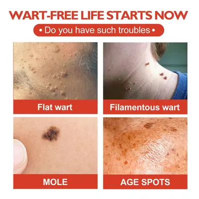 OUHOE Acne Patch for Blackheads, Skin Tags, Warts and Corn Spots - 3