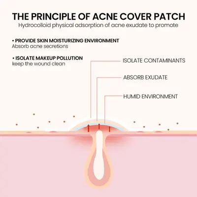 Jaysuing Acne Patch for Closed Comedones - 4