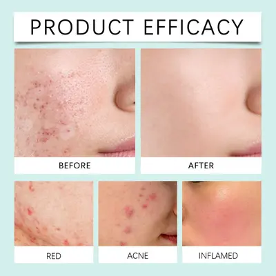 EELHOE Akne-Patch Hautpflege-Set sanfte Reinigung