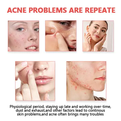 Acne Patch Series for Pore Cleansing and Skin Balancing - 5