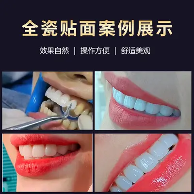 Yiohjia All-Ceramic Dental Veneer Porcelain Laminate, Blue Ceramic, Amber Ceramic, Lingxi Ceramic, Handmade Porcelain, Fluorosis Teeth Whitening Teeth - 4