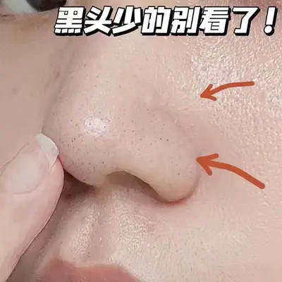 VSEA Blackhead Removal Nose Strip, Moisturizing and Refreshing, Pore Minimizing