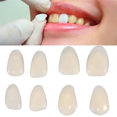 Zahnfurniere Veneers A1 A2 Farbe Zahnschalen provisorische Zahnverblendungen Dental-Material Zahnveneers