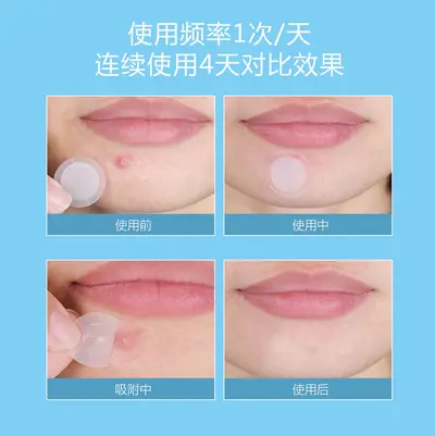 定制微晶痘痘贴玻尿酸水胶体痘痘贴可溶性微晶痘痘贴痘痘贴oem