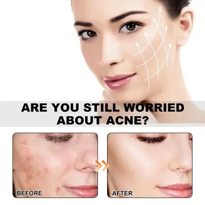 Limited-time discount Jaysuing cute colorful acne patches, fade pimples and blackheads, care for facial skin, concealer