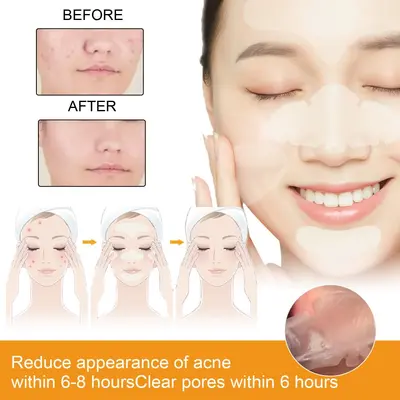 EELHOE hydrogel acne patch, portable, invisible